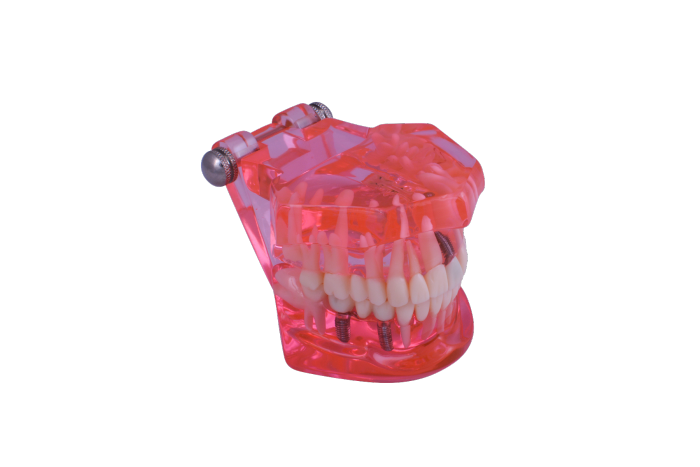 3D Dental Educational Restoration Model W/Implant