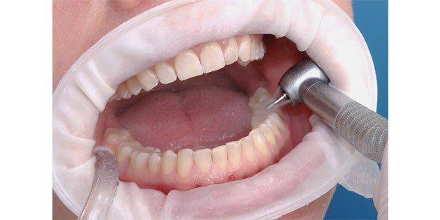 Ivoclar Vivadent Optragate refill kit regular 80/pkg