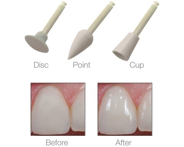 Pacdent iGlo Silicon Polisher Combo Kit: 10 x cups, 10 x discs and 10 x points