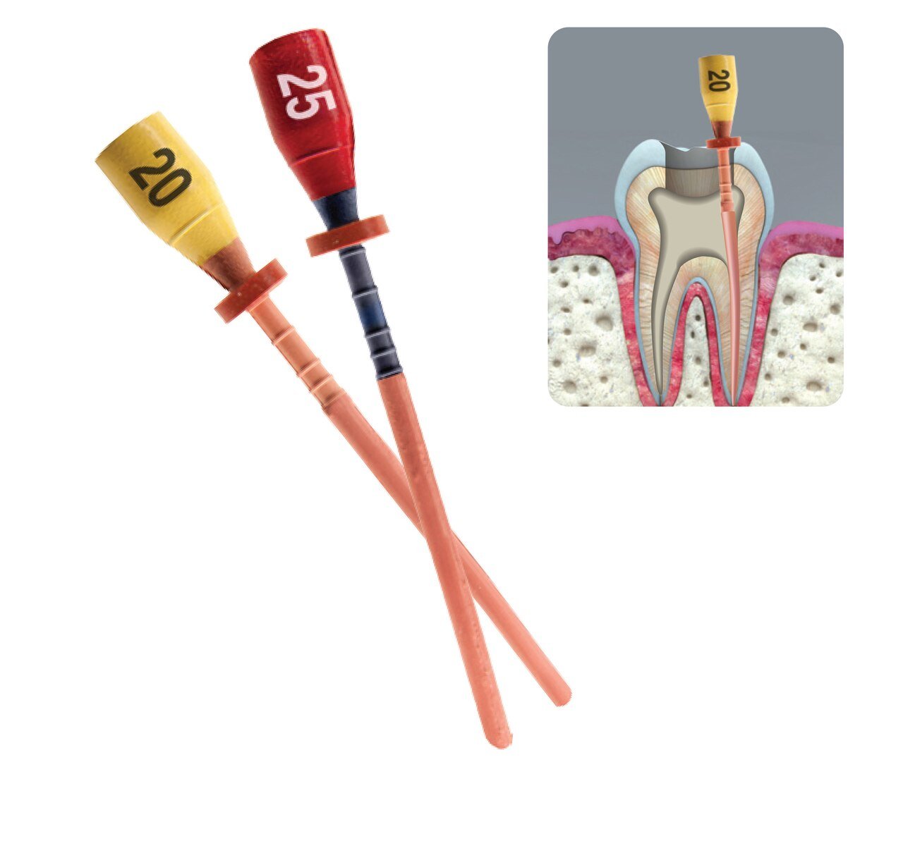 Pacdent Pac-Taper GPC Obturator, Gutter Percha Carrier, 5 x #A1 GPC Obturators + 1 x #20 verifier