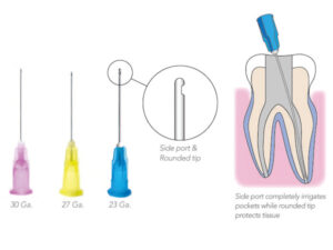 PacDent OptiProbe™ Needle Tips - 30 Ga., side port, purple